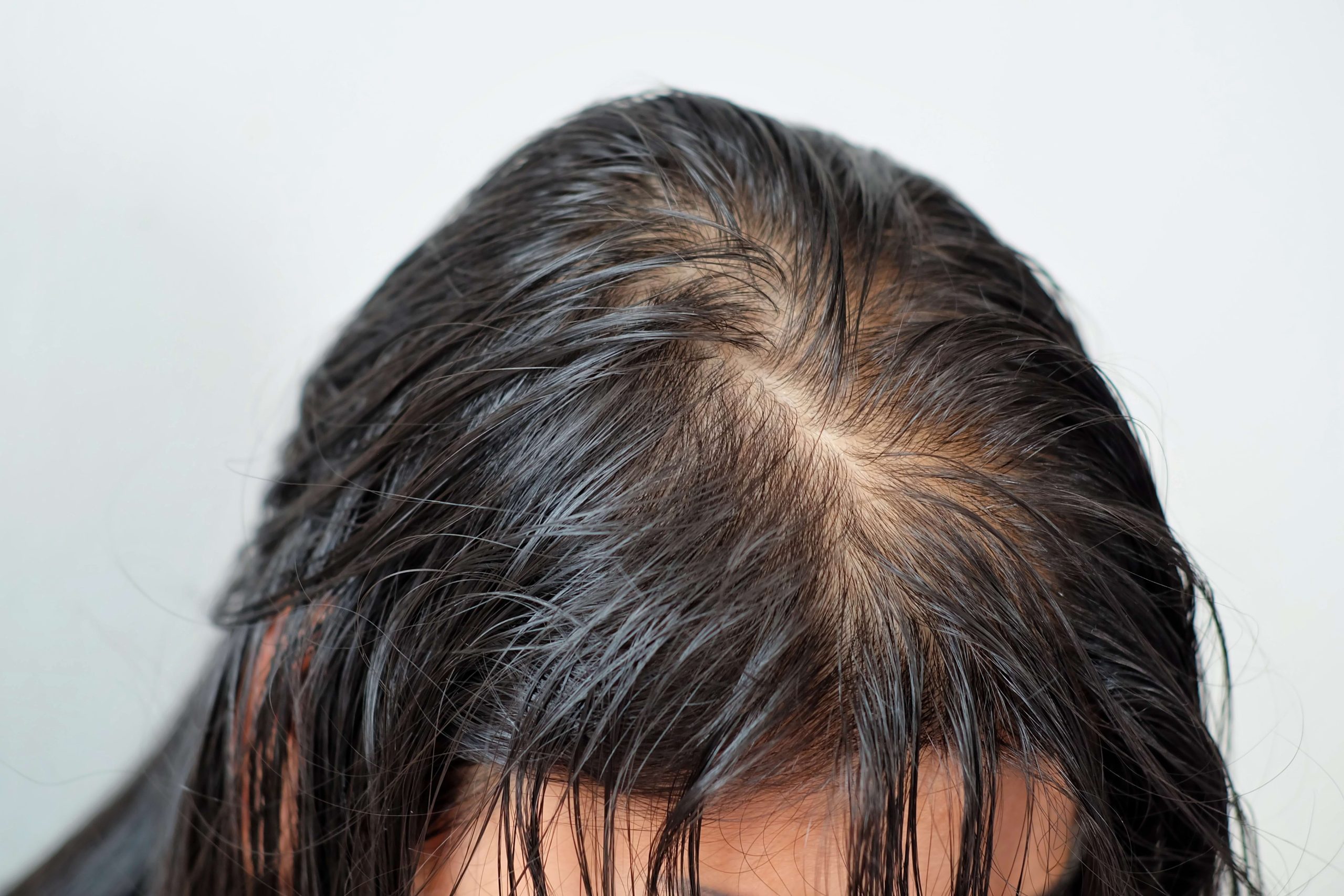 Σαμπουάν για τριχόπτωση από Kyana: Για άνδρες και γυναίκες